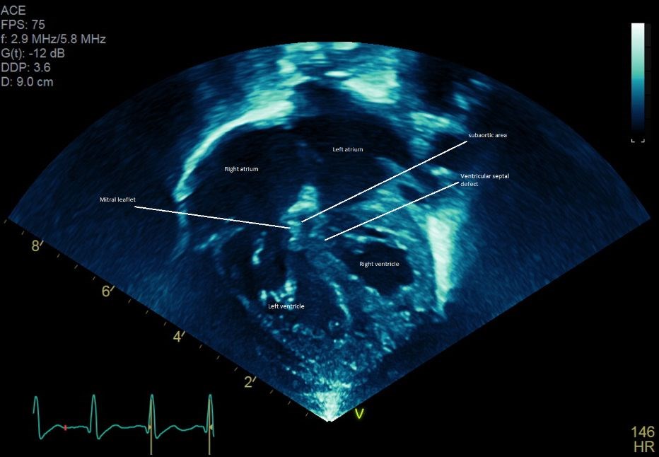 3D Printed Heart Model Helps Cardinal Glennon Children’s Hospital Plan Complex Surgeries